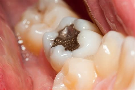 How Tooth Decay Can Be Prevented