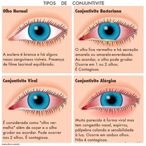 Como Começar A Conjuntivite