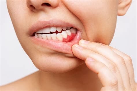 What Causes Swollen Gums? - Village Periodontics & Dental Implant Center