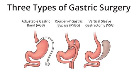 8 Gastric Surgery Types to Choose - Weight Loss Surgery