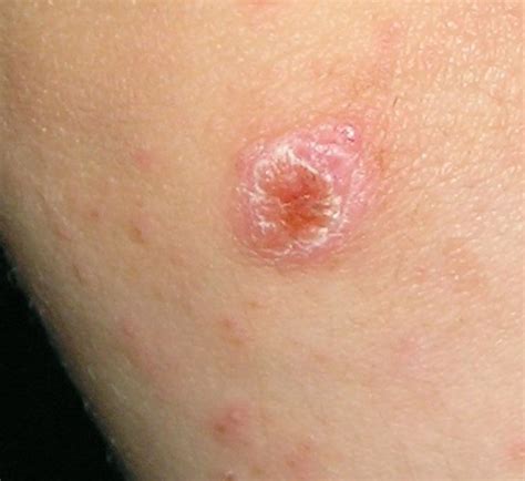 spider bite pictures symptoms  treatments youmemindbody
