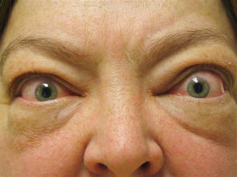 Graves Disease - Causes, Signs, Symptoms, Medication, Treatment