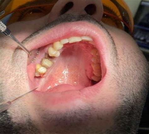 (condition before extraction of the teeth) | Download Scientific Diagram