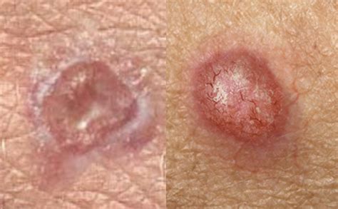 main type  skin cancer  differences histology  prevention