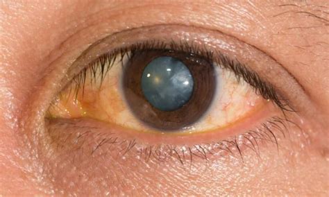 Posterior Subcapsular Cataracts: Signs, Causes And Treatments
