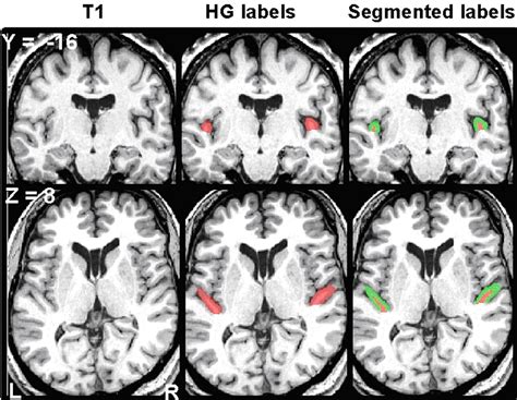Relating Structure to Function: Heschl's Gyrus and Acoustic Processing