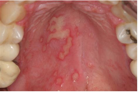 secondary herpetic gingivostomatitis