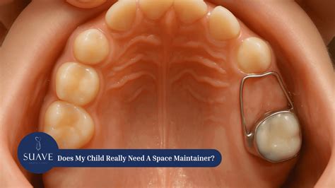 child    space maintainer