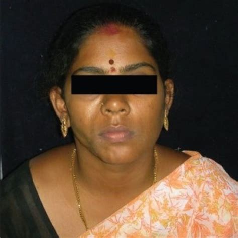 A 28-year-old female patient with facial asymmetry and sunken right cheek. | Download Scientific ...