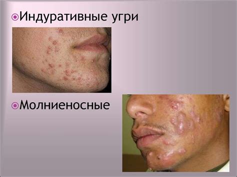 Угревая болезнь - презентация онлайн