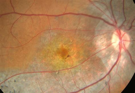 cone dystrophy clinical tree
