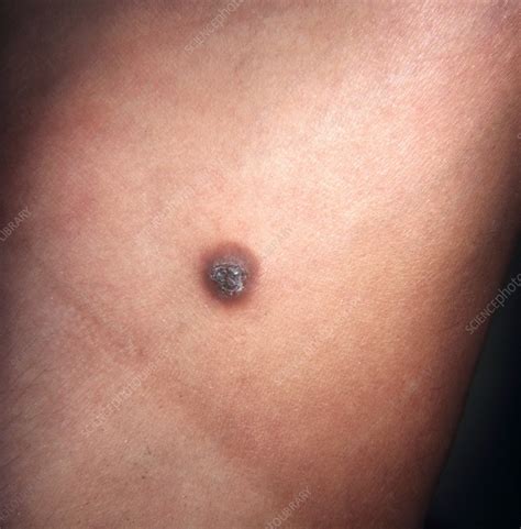 Dermatofibroma Dermoscopy