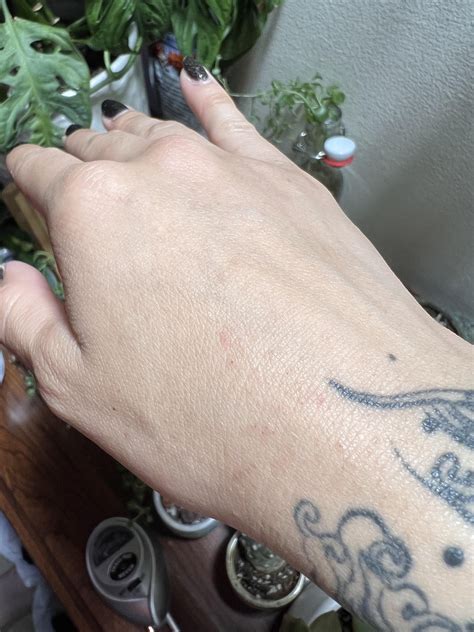 Help with clusters of tiny itchy bumps on hands and neck! : r