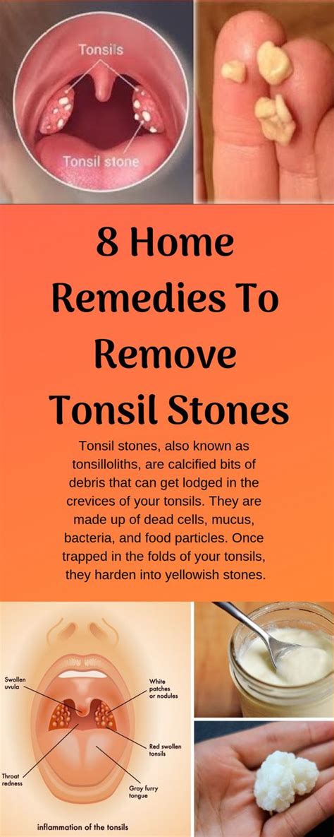 Tonsillitis Treatment