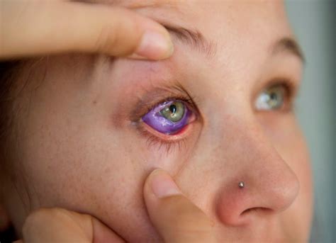 Artist defends eyeball tattoo that left Ottawa woman with partial ...