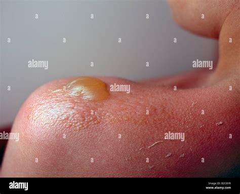 sunburn blisters  christopher prior blog