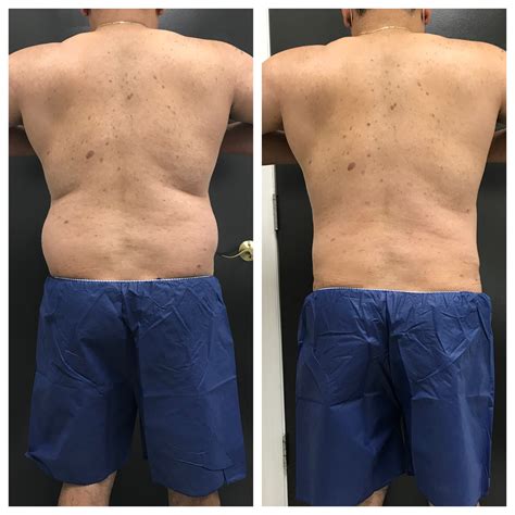 lipectomie abdominale prix les aliments qui font gonfler le ventre