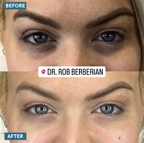 Under Eye Filler Newport Beach | Orange County | Dark Circles & Hollowness | Dr. Rob Berberian