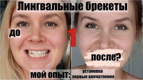 Эпизод 1. Лингвальные брекеты. Установка, первые впечатления. - YouTube