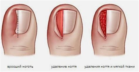 Резекция ногтя : лечение вросшего ногтя в Одессе