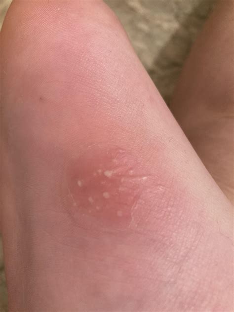 What is this!? Need help. Hot to touch, super painful, happened after