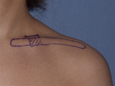 Locaton of Bone Removal and Skin Incision for Clavicuar Reduction Dr