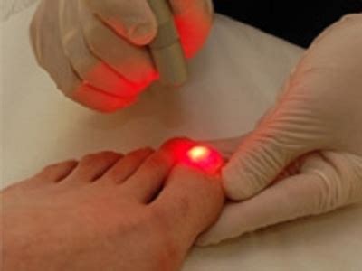 Get Laser Fungal Nail Treatment Online by Suncoast Podiatry on Dribbble