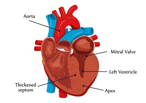 Hypertrophic Cardiomyopathy - NUHCS | National University Heart Centre