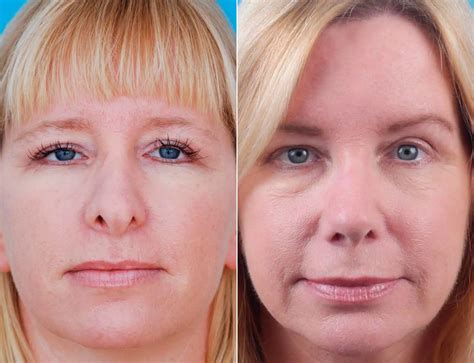 What is the Average Cost of Rhinoplasty? | Dr. Daniel Becker