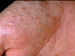 Dyshidrotic Eczema Arms