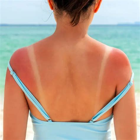 WebMD Skin Treatment Center - Find skin treatment information on ...