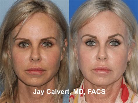 Fox Eye Surgery - Fox Eye Lift Beverly Hills