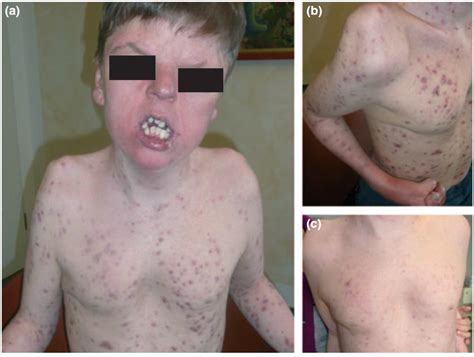 Biomedicines | Free Full-Text | Acne Syndromes and Mosaicism