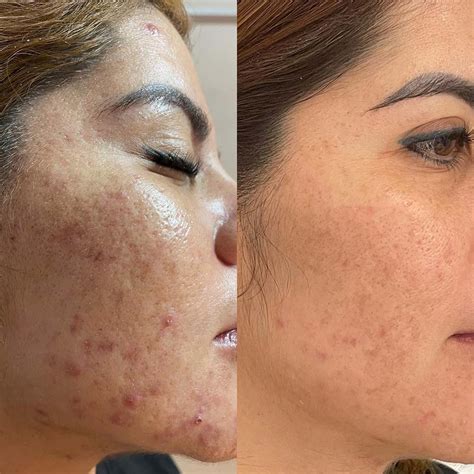 Chemical Peels On Body: The Ultimate Guide 2023, 43% OFF