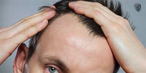 ways  defeat  worst enemy receding hairline ahs india