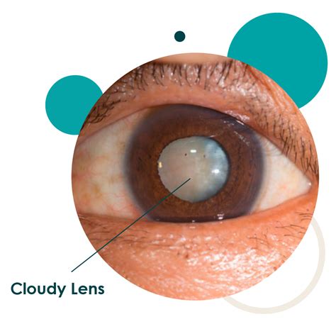 glaucoma  eye specialist southkey