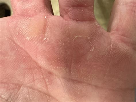 Mastering Callus Care: 3 Signs Your Calluses Need Attention – SandBar ...