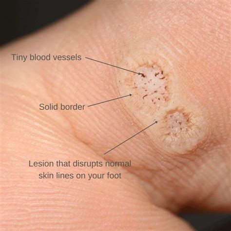 plantar wart