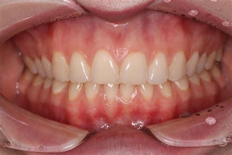 Что такое правильный прикус и почему он важен? | Dentell