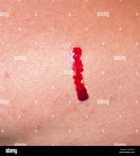 face dermal bleeding  jayden nobbs blog