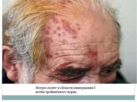 Вирусные дерматозы - презентация онлайн