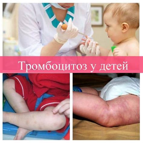 Тромбоцитоз у ребенка | Trombanet