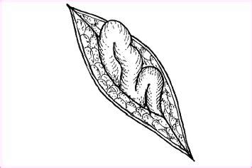 nurse base recognizing dehiscence  evisceration