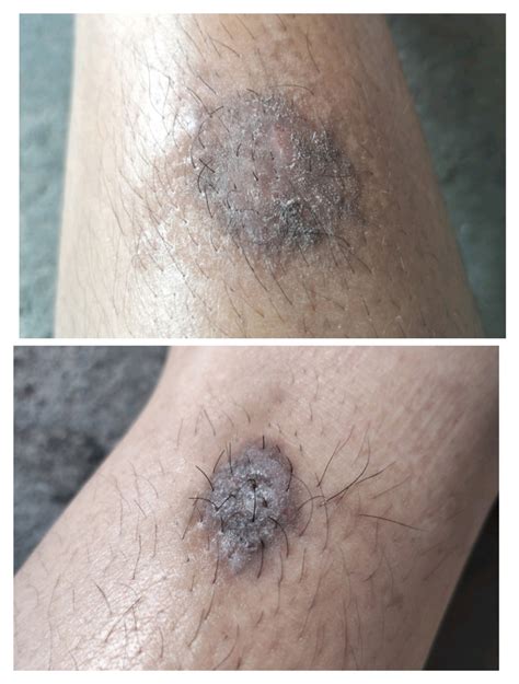 gatal menghitam hellosehat