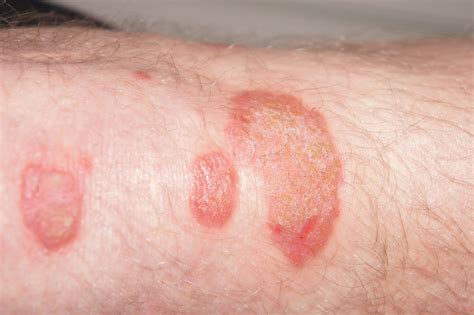 Skin Diseases Psoriasis