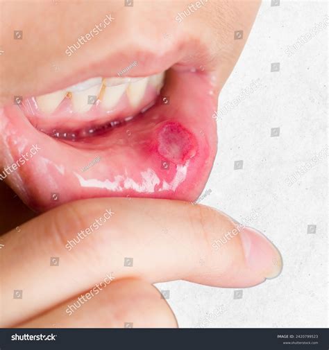 Close On Lip Aphthous Stomatitis Aphthous Stock Photo 2420799523