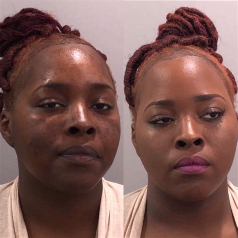Lupus Rash | Lupus on the Skin | Lupus Scars | Makeup for Lupus|Lupus