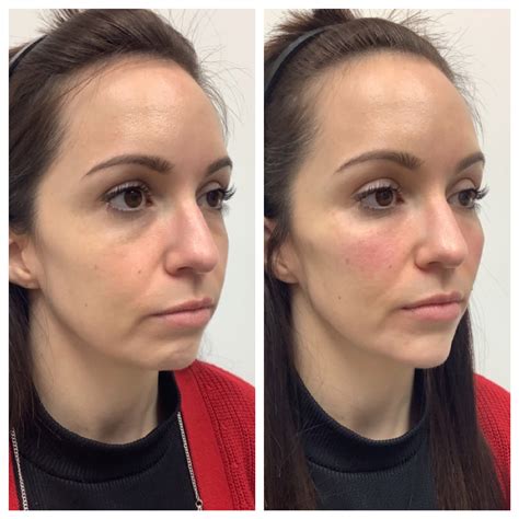 Chin Filler Near Me | See Before/Afters | Nectar Aesthetics