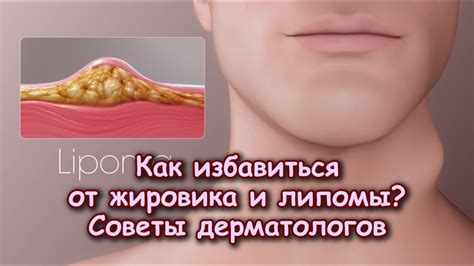 КАК ИЗБАВИТЬСЯ ОТ ЖИРОВИКА, ЛИПОМЫ. Советы дерматологов - YouTube