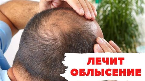 НЕВЕРОЯТНАЯ ДЕЙСТВУЮЩАЯ маска от ОБЛЫСЕНИЯ - YouTube